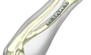 Placa para Antebrazo